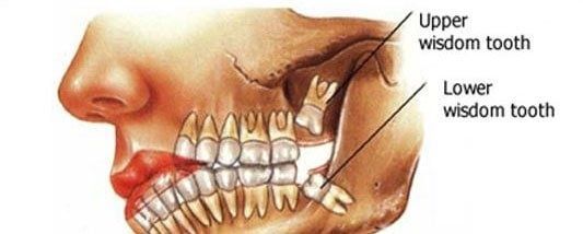 Do All 4 Wisdom Teeth Come in at the Same time